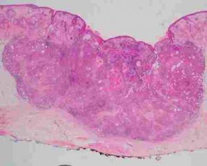 Cutaneous SCC (H&E stain)